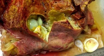 Ехінококоз печінки симптоми і профілактика (печінки) Ехінококоз печінки симптоми і профілактика