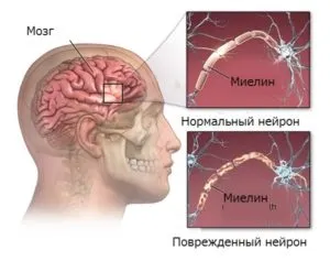 Вагітність і розсіяний склероз причини, чи можна народжувати (склероз) Вагітність і розсіяний склероз причини, чи можна народжувати