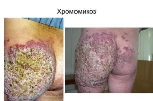 Глибокі мікози види захворювання, симптоми, лікування (лікування) Глибокі мікози види захворювання, симптоми, лікування