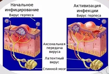 Герпес на мові як лікувати, причини і симптоми (лікувати) Герпес на мові як лікувати, причини і симптоми