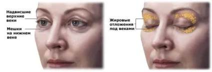 Грижі під очима як позбутися без операції, причини і лікування, блефаропластика, як відрізнити від (грижі) Грижі під очима як позбутися без операції, причини і лікування, блефаропластика, як відрізнити від