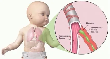 Інгаляції небулайзером при сухому і мокрому кашлі у дітей - рецепти