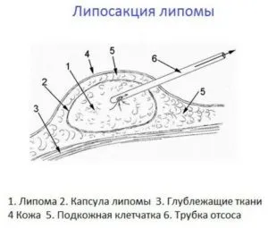 Які мазі від жировик (ліпоми) найбільш ефективні (ефективні) Які мазі від жировик (ліпоми) найбільш ефективні