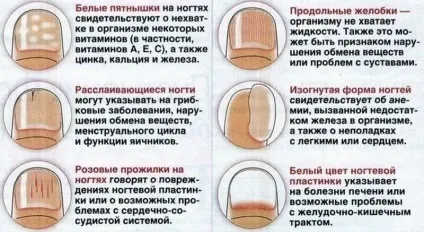 Які зміни нігтів виникають в результаті внутрішніх захворювань (захворювань) Які зміни нігтів виникають в результаті внутрішніх захворювань