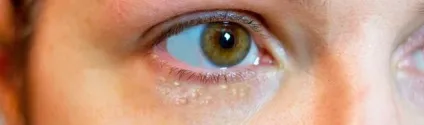 Як позбутися від міліуми під очима