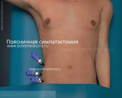 Як позбутися пітливості ніг поперековий симпатектомія, інтернет-журнал (пітливості) Як позбутися пітливості ніг поперековий симпатектомія, інтернет-журнал