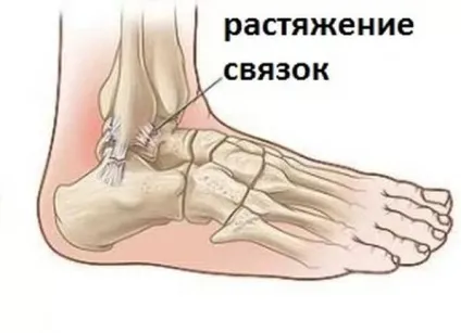 Як лікувати розтягнення зв'язок гомілкостопу (лікувати) Як лікувати розтягнення зв'язок гомілкостопу