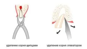 Чи боляче видаляти зуб