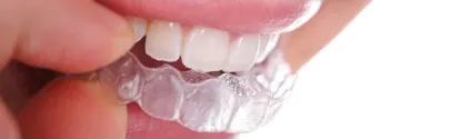 Брекети invisalign (сша) - ефективні і невидимі для оточуючих (брекети) Брекети invisalign (сша) - ефективні і невидимі для оточуючих