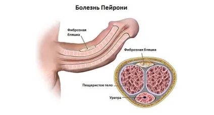 Хвороба Пейроні причини, симптоми, методи лікування (симптоми) Хвороба Пейроні причини, симптоми, методи лікування
