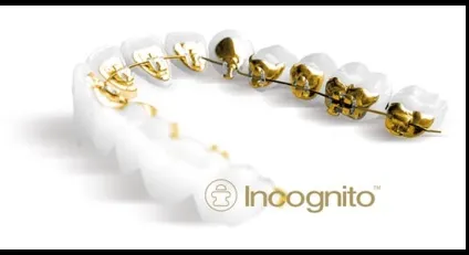 Брекети incognito (інкогніто) відгуки, ціни, фото (incognito) Брекети incognito (інкогніто) відгуки, ціни, фото