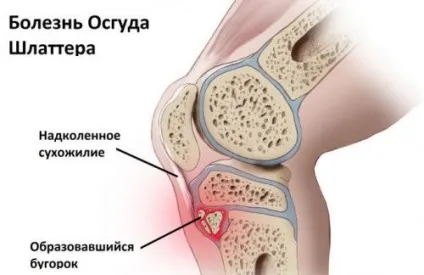 Хвороба Осгуд-Шляттера у підлітків і дітей, лікування колінного суглоба (дітей) Хвороба Осгуд-Шляттера у підлітків і дітей, лікування колінного суглоба