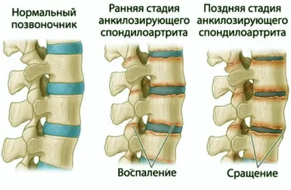 Виразкової хвороби шлунку, або анкілозуючийспондиліт - симптоми, причини розвитку та методи лікування (симптоми) Виразкової хвороби шлунку, або анкілозуючийспондиліт - симптоми, причини розвитку та методи лікування