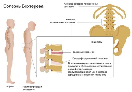 Виразкової хвороби шлунку, або анкілозуючийспондиліт - симптоми, причини розвитку та методи лікування (хвороба) Виразкової хвороби шлунку, або анкілозуючийспондиліт - симптоми, причини розвитку та методи лікування