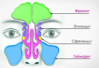 Як відрізнити нежить від гаймориту у дорослих основні моменти (відрізнити) Як відрізнити нежить від гаймориту у дорослих основні моменти