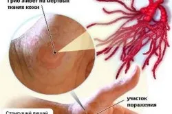 Як передається стригучий лишай