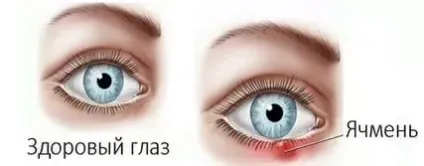 Як запобігти ячмінь лікування на ранніх стадіях (ячмінь) Як запобігти ячмінь лікування на ранніх стадіях