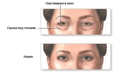 Як прибрати грижі під очима в домашніх умовах (очима) Як прибрати грижі під очима в домашніх умовах