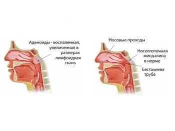 Як видаляють аденоїди у дітей