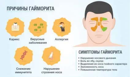 Як вилікувати гайморит в домашніх умовах антибіотиками і народними засобами без проколу назавжди (народними) Як вилікувати гайморит в домашніх умовах антибіотиками і народними засобами без проколу назавжди