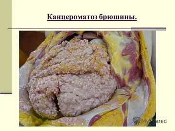 Канцероматоз очеревини виживаність