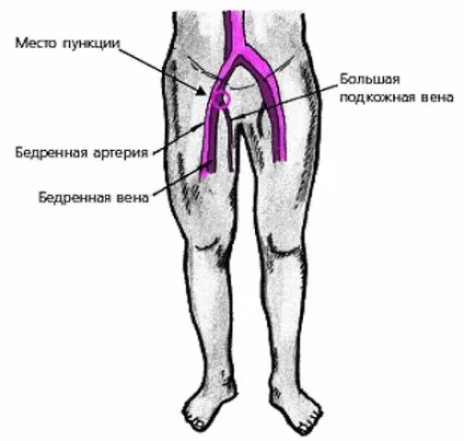 Катетеризація стегнової вени - шпаргалки для швидкої допомоги (вени) Катетеризація стегнової вени - шпаргалки для швидкої допомоги