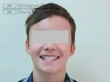 Ікло не встає в ряд - лікування брекетами (підліток 12 років) частина 1 (ортодонтичне лікування) Ікло не встає в ряд - лікування брекетами (підліток 12 років) частина 1