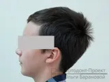 Ікло не встає в ряд - лікування брекетами (підліток 12 років) частина 1 (лікування) Ікло не встає в ряд - лікування брекетами (підліток 12 років) частина 1