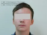 Ікло не встає в ряд - лікування брекетами (підліток 12 років) частина 1 (брекетами) Ікло не встає в ряд - лікування брекетами (підліток 12 років) частина 1