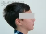 Ікло не встає в ряд - лікування брекетами (підліток 12 років) частина 1 (лікування на брекетах) Ікло не встає в ряд - лікування брекетами (підліток 12 років) частина 1