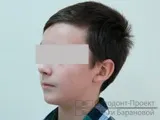 Ікло не встає в ряд - лікування брекетами (підліток 12 років) частина 1 (ортодонт) Ікло не встає в ряд - лікування брекетами (підліток 12 років) частина 1