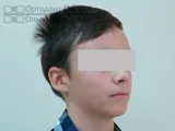 Ікло не встає в ряд - лікування брекетами (підліток 12 років) частина 1 (ортодонтичне лікування) Ікло не встає в ряд - лікування брекетами (підліток 12 років) частина 1