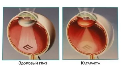Класифікація катаракт