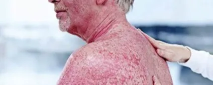 Фото і симптоми псоріазу, лікування псоріазу в домашніх умовах, як лікувати псоріаз, причини (псоріаз на фото) Фото і симптоми псоріазу, лікування псоріазу в домашніх умовах, як лікувати псоріаз, причини