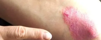 Фото і симптоми псоріазу, лікування псоріазу в домашніх умовах, як лікувати псоріаз, причини (сайт про псоріаз) Фото і симптоми псоріазу, лікування псоріазу в домашніх умовах, як лікувати псоріаз, причини
