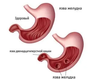 Чим зняти біль при виразці шлунка і дванадцятипалої кишки (біль) Чим зняти біль при виразці шлунка і дванадцятипалої кишки
