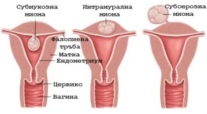 Чим відрізняється міома від фіброми матки