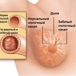 Лактостаз- як боротися з застоєм молока, зайплюшкі (застій молока) Лактостаз- як боротися з застоєм молока, зайплюшкі
