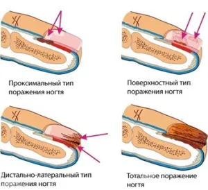 Лікування запущеної форми грибка нігтів народними засобами (запущеної) Лікування запущеної форми грибка нігтів народними засобами