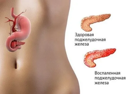 Лікування підшлункової залози, панкреатит (чим лікується підшлункова залоза) Лікування підшлункової залози, панкреатит