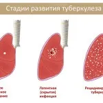 Ліки від туберкульозу легенів антибіотики та інші препарати і таблетки (антибіотики) Ліки від туберкульозу легенів антибіотики та інші препарати і таблетки