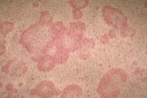 Лишай у паху чи потрібно лікувати хворобу або вона сама пройде (паху) Лишай у паху чи потрібно лікувати хворобу або вона сама пройде