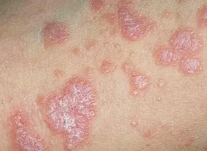 Лишай у паху чи потрібно лікувати хворобу або вона сама пройде (потрібно) Лишай у паху чи потрібно лікувати хворобу або вона сама пройде