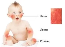 Мазь від діатезу для лікування немовлят і дорослих (діатезу) Мазь від діатезу для лікування немовлят і дорослих