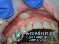 Методи і техніка місцевої анестезії, види (анестезія резцовая) Методи і техніка місцевої анестезії, види
