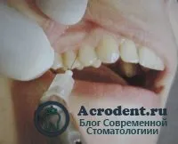 Методи і техніка місцевої анестезії, види (види) Методи і техніка місцевої анестезії, види