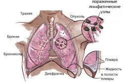 Метастази в легенях кашель при метастазах, осередки (кашель) Метастази в легенях кашель при метастазах, осередки