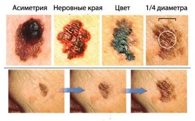 Меланоцитарний невус - причини, симптоми і лікування