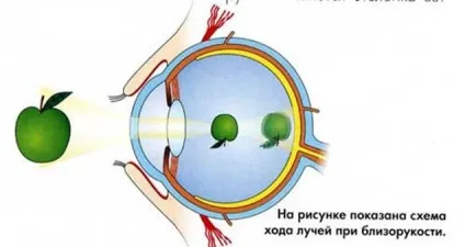 Міопія у дітей ступеня міопії, причини короткозорості, лікування і корекція міопії за допомогою окулярів і (короткозорості) Міопія у дітей ступеня міопії, причини короткозорості, лікування і корекція міопії за допомогою окулярів і