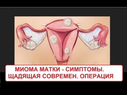 Міома матки симптоми і ознаки, як розпізнати (розпізнати) Міома матки симптоми і ознаки, як розпізнати